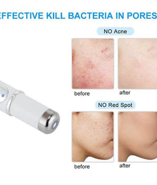Blue Light Therapy Acne Pen Soft Scar Wrinkle Removal Device Relax