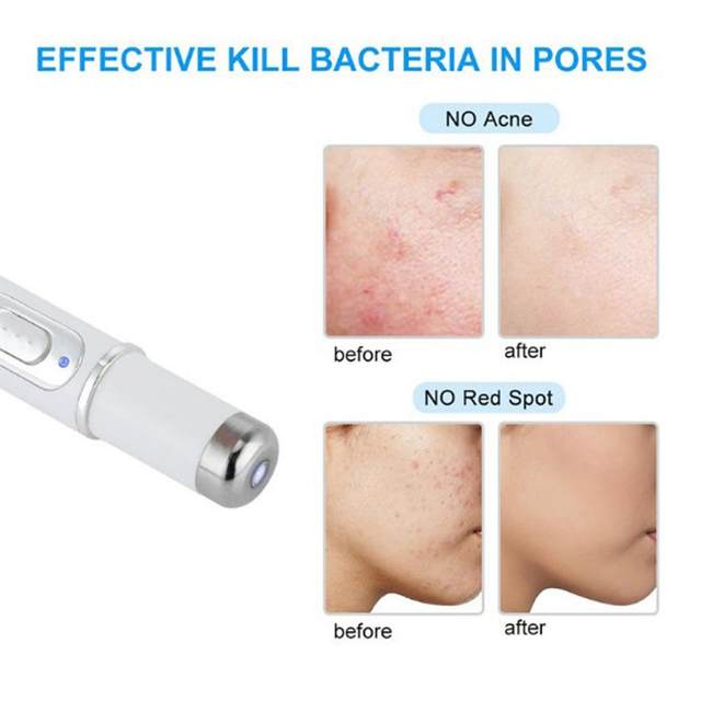 Blue Light Therapy Acne Pen Soft Scar Wrinkle Removal Device Relax
